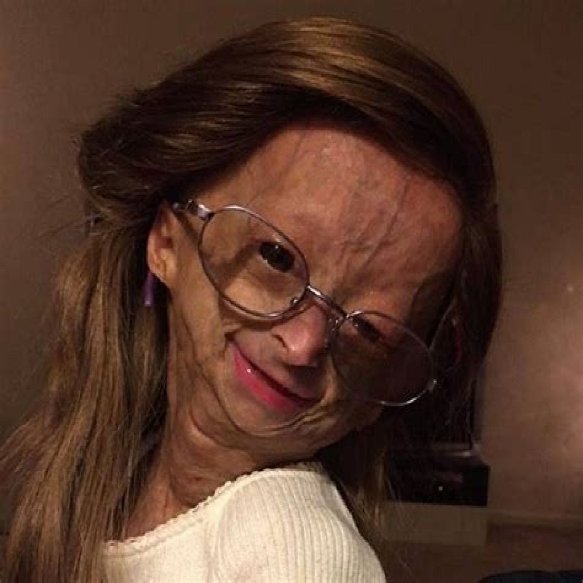 Adalia Rose: A Journey Of Inspiration And Resilience
